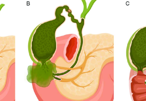 Biến chứng nguy hiểm khi viêm túi mật cấp không được điều trị kịp thời
